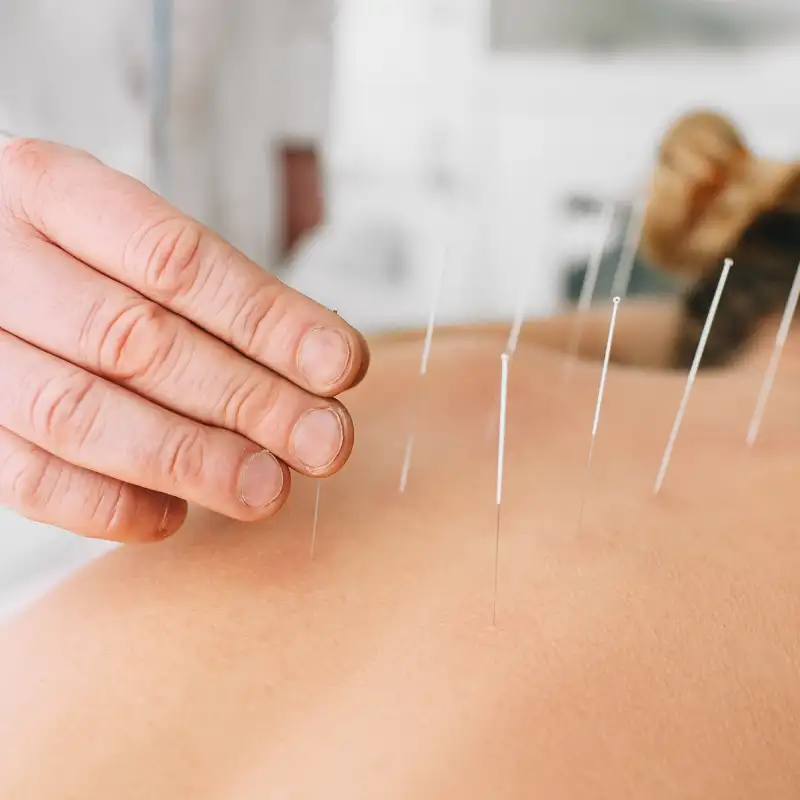 Terapia de Acupuntura y Salud Integral en Puebla Especialista aplicando técnica de acupuntura para salud cuerpo-mente en clínica de Puebla, cerca de Plaza Dorada.